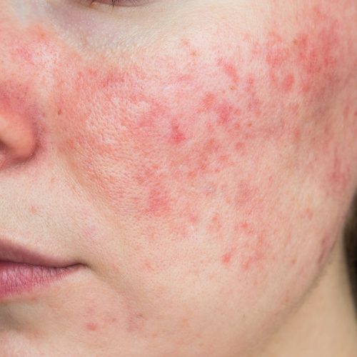 Akne - Hautsache Gesund bei Contourlines