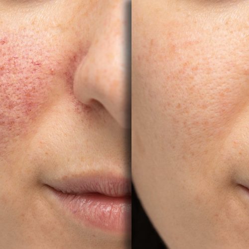 Akne Hautsache Gesund bei Contour Lines