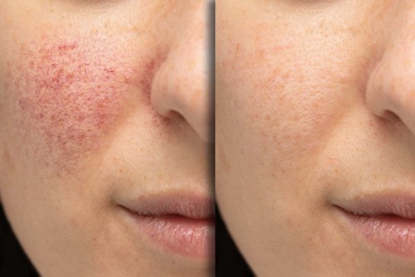 Before and after laser treatment for rosacea