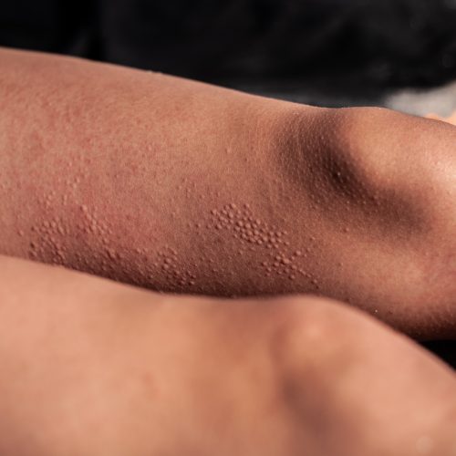 Sonnenallergie - Hautsache Gesund bei Contourlines