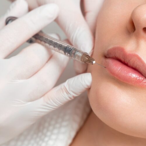 Lippen aufspritzen mit Hyaluron für natürliche Lippenvergrößerung und Lippenmodellierung