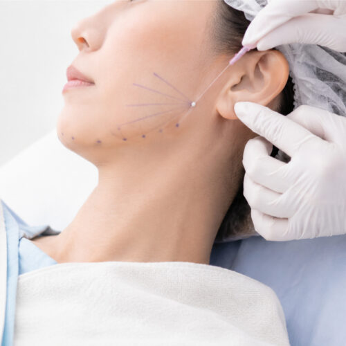 Fadenlifting Behandlung zur Kollagenstimulation im Gesicht